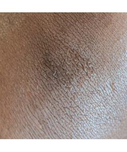 Pigmentation and Vascular